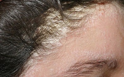 Ngứa da đầu do bệnh viêm da tiết bã dùng Eczestop có hiệu quả không?